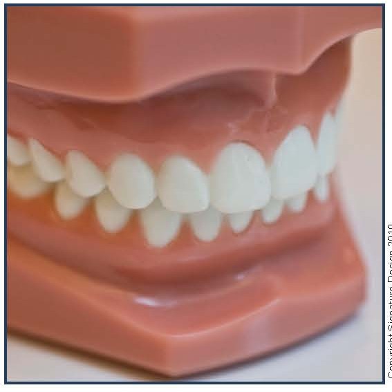 Bonded Lingual Retainer (BLR)