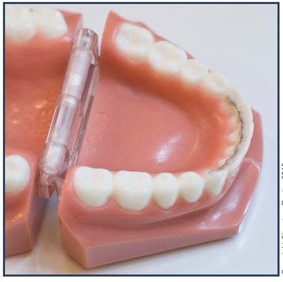 Bonded Lingual Retainer (BLR)