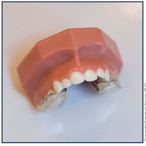 Bonded Palatal Expansion Appliance (BPE)
