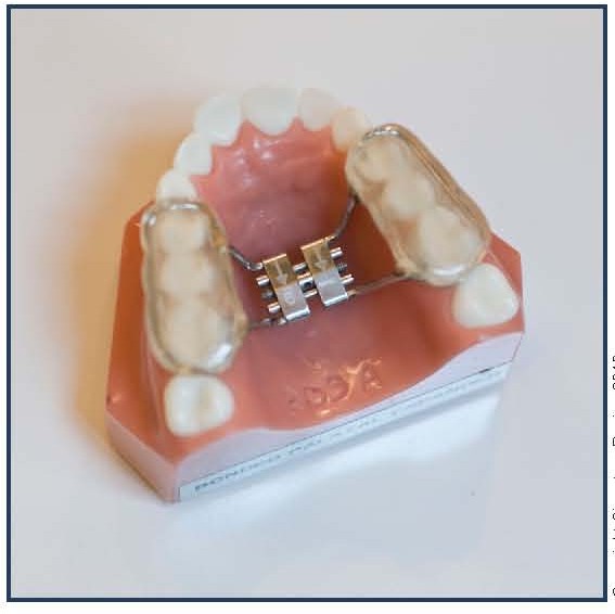 Bonded Palatal Expansion Appliance (BPE)