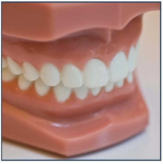 Bonded Palatal Retainer (BPR)