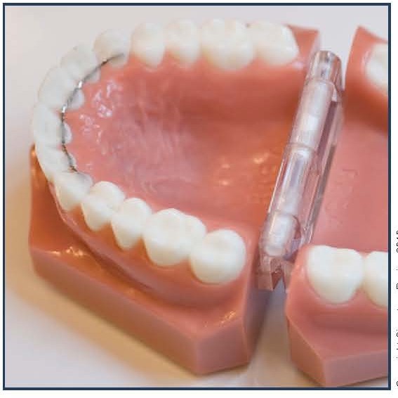 Bonded Palatal Retainer (BPR)