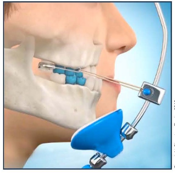 The Facemask