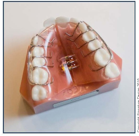 Removable Palatal Expansion Appliance (KDE)