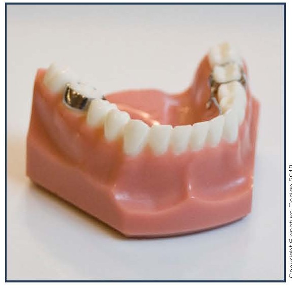 Lower Lingual Holding Appliance (LLHA)