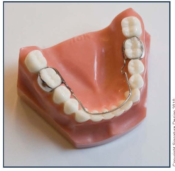 Lower Lingual Holding Appliance (LLHA)