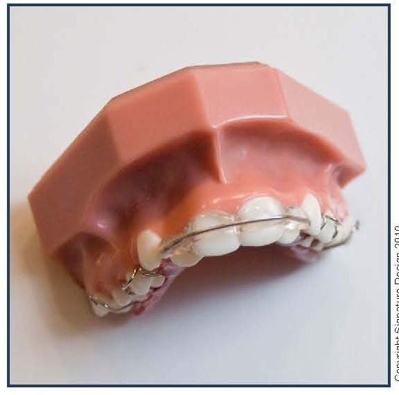 Molar Distalization Appliance (MDA)