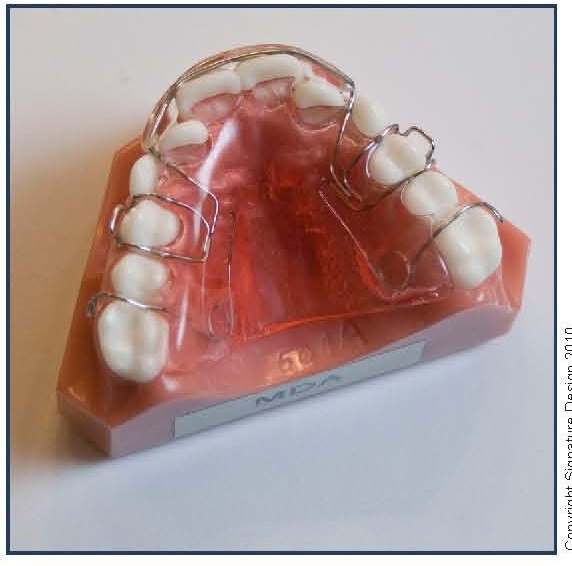 Molar Distalization Appliance (MDA)