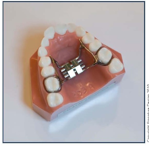 Banded Palatal Expander (PE)