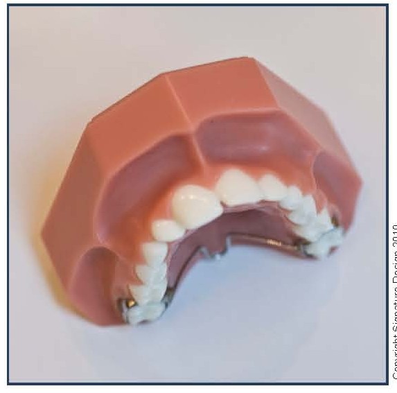 Trans-Palatal Arch (TPA)