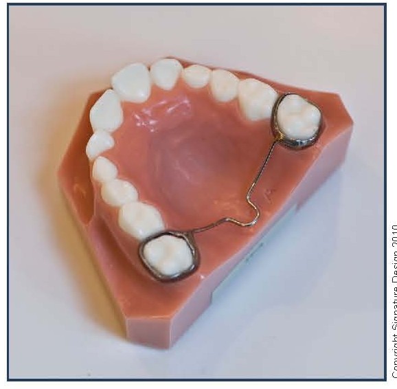 Trans-Palatal Arch (TPA)
