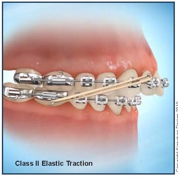 Elastics