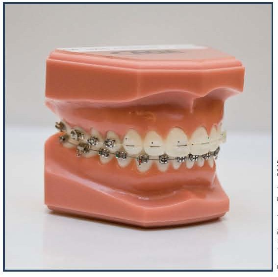 Ceramic (Clear) Braces (Upper) with Stainless Steel Braces (Lower)