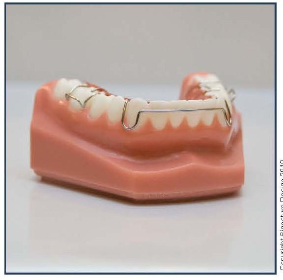 Mandibular Hawley Appliance