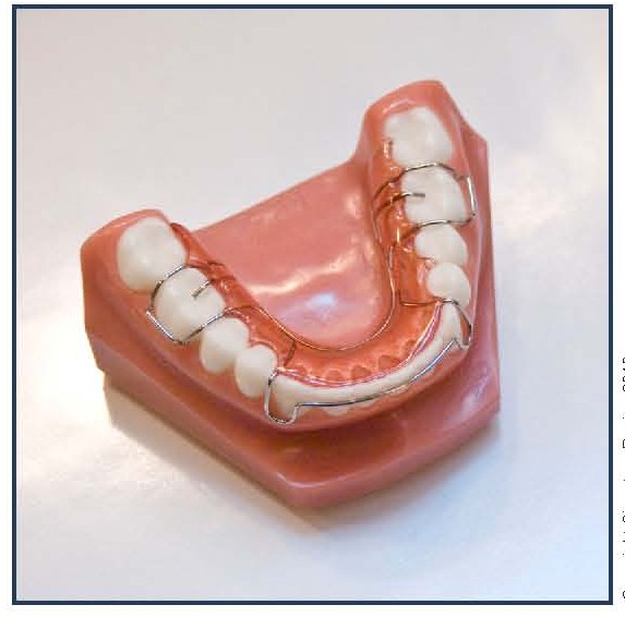 Mandibular Hawley Appliance