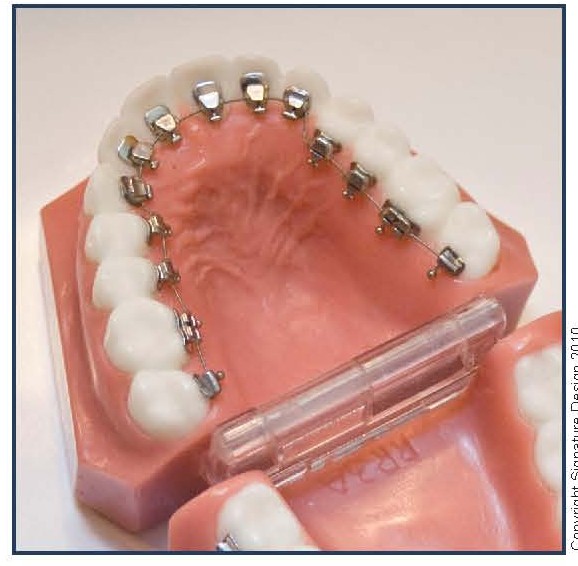 Lingual (Invisible) Upper Braces with Clear Composite Lower Braces