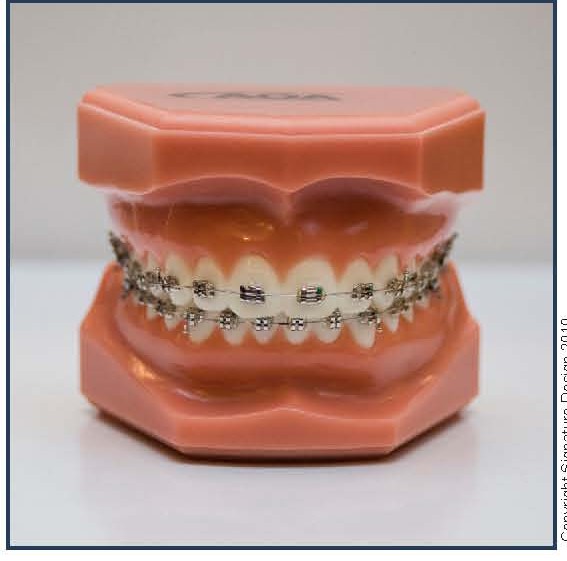 Standard Braces