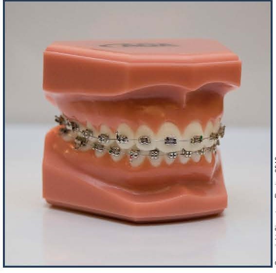 Standard Braces